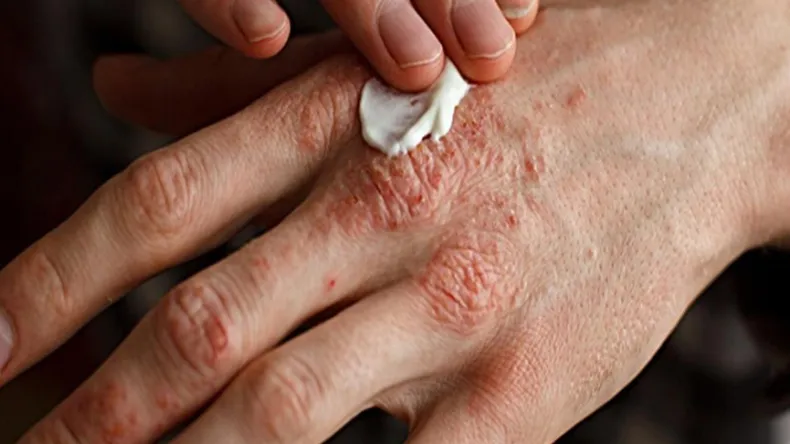 الجزائر أمام سيناريو وبائي صامت الأمراض الجلدية تخرج عن السيطرة 